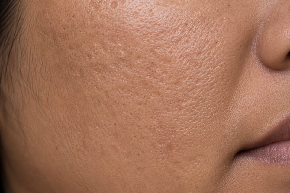 Uneven Texture